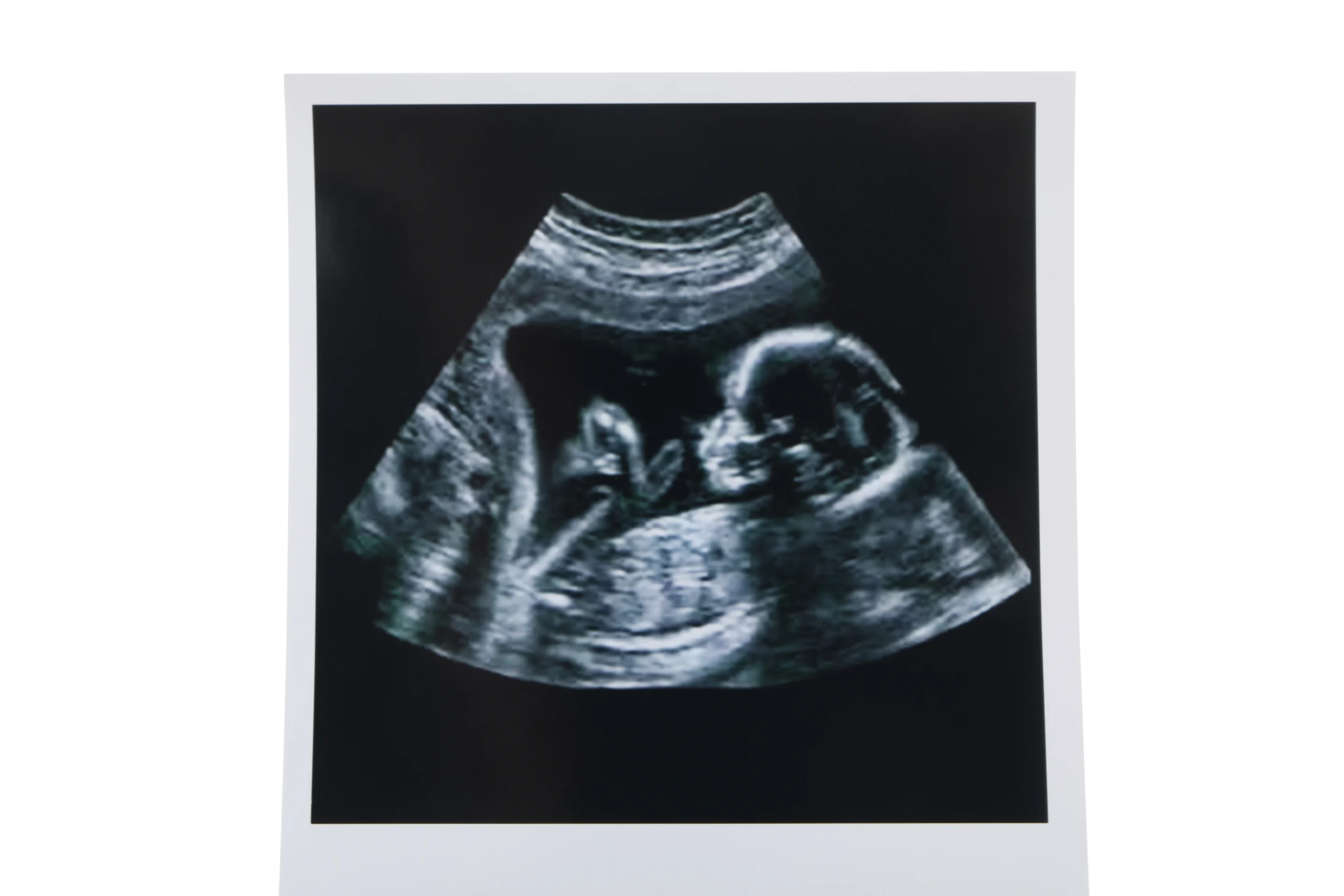 Picture of a sonogram.